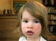 Причины красных щек у ребенка и способы лечения