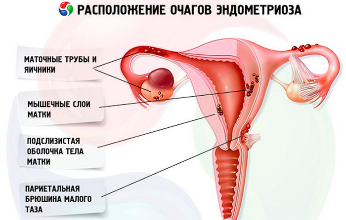 Расположение очагов эндометриоза