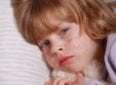 Розеола детская: симптомы и лечение заболевания