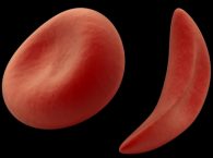 Серповидноклеточная анемия: как помочь подросткам и родителям