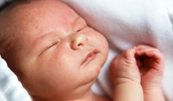 Что нужно знать о сыпи у младенцев