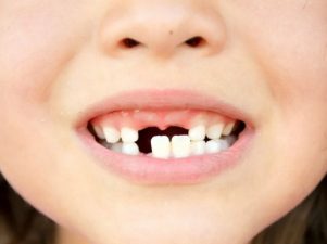 Что нужно знать о выпадении молочных зубов