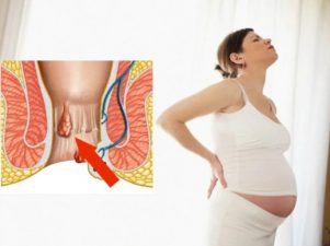 Что вызывает геморрой во время беременности
