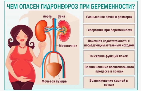 Что нужно знать о гидронефрозе во время беременности