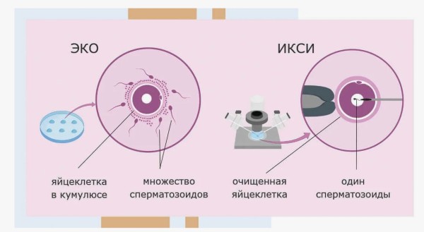 Что такое ЭКО