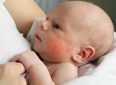 Стрептококковые заболевания группы В у новорожденных