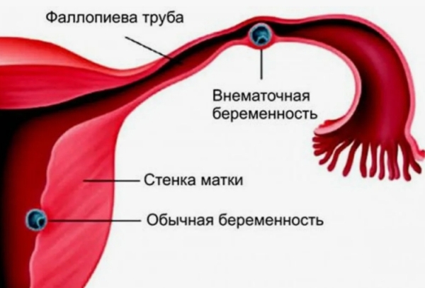 Каковы признаки ненормальной беременности