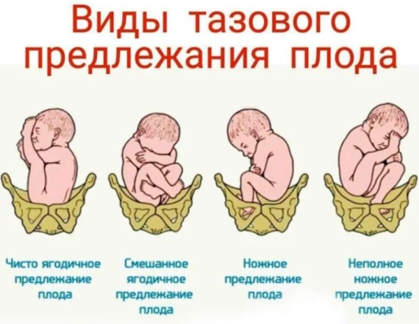 Что означают разные положения ребенка в утробе матери