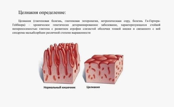 Признаки целиакии у ребенка