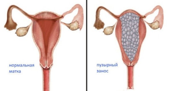 Что такое частичная молярная беременность