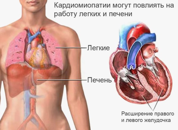 Что такое перипартальная кардиомиопатия