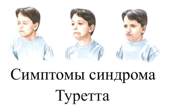 Что такое синдром Туретта у ребенка
