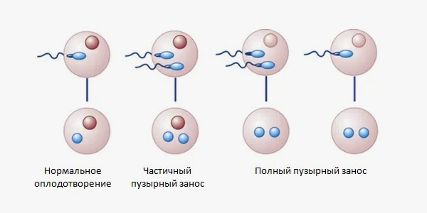 Что такое полная молярная беременность