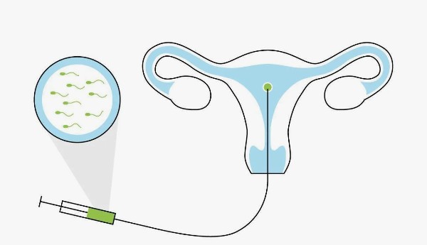 Как проводят искусственное оплодотворение