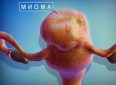 10 самых любопытных вопросов о миоме