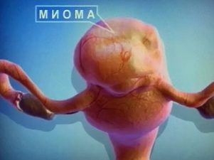 10 самых любопытных вопросов о миоме