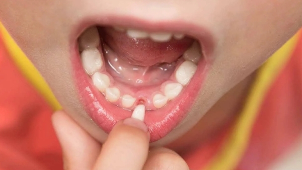 В каком порядке выпадают молочные зубы