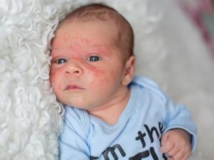 Симптомы атопического дерматита у детей