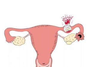 Опасности внематочной беременности