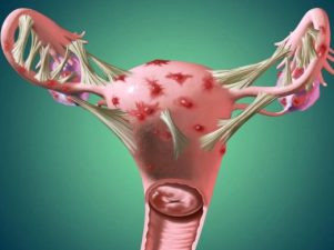 Как эндометриоз влияет на фертильность