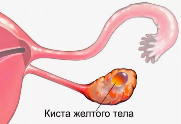 Что нужно знать о желтом теле при попытке забеременеть