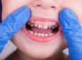 7 причин разрушения зубов у детей
