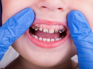 7 причин разрушения зубов у детей