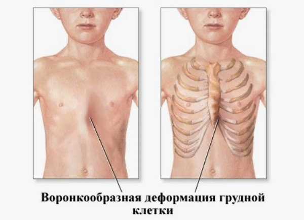 Деформации грудной клетки у детей